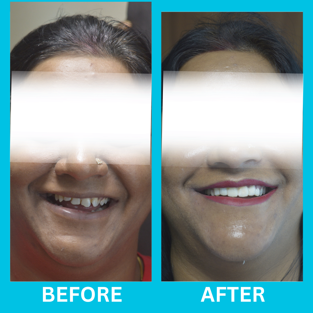 Dental Result 4