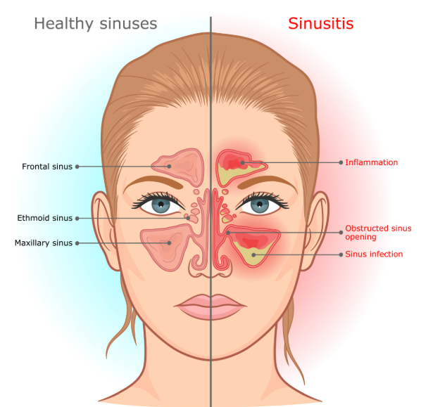 An anatomical illustration comparing healthy sinuses on the left with inflamed, blocked sinuses on the right, highlighting sinus infection in red and yellow and explaining how these issues can overlap with metallic taste in mouth dental causes.