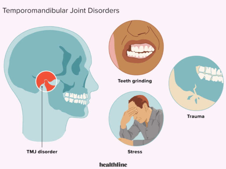Illustration showing causes of TMJ disorders—teeth grinding, stress, and jaw trauma.