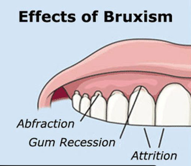 "Illustrated diagram labeled with the dental effects of bruxism, including abfraction, gum recession, and attrition.