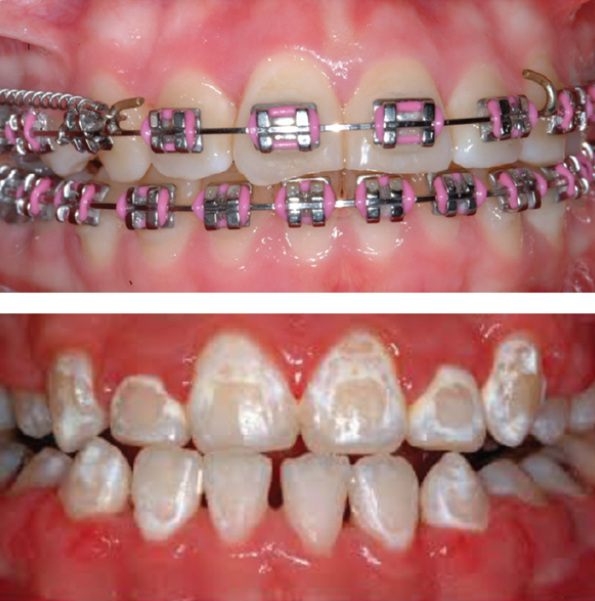 Comparison showing teeth with braces and white spot lesions on the enamel after orthodontic treatment.