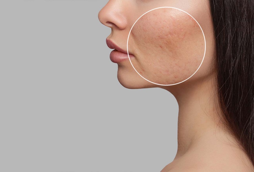 How to Reduce Acne Marks