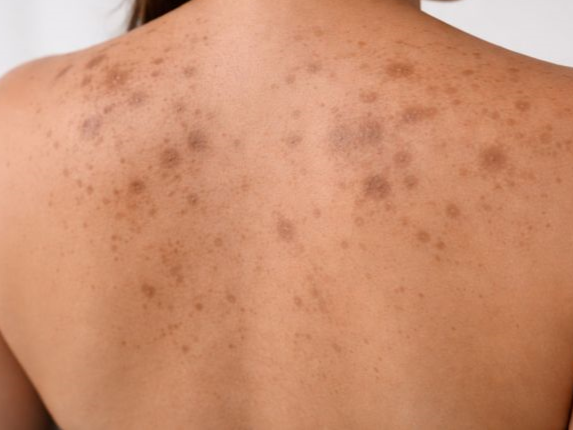 Image showing multiple dark spots and pigmentation on the upper back skin.
