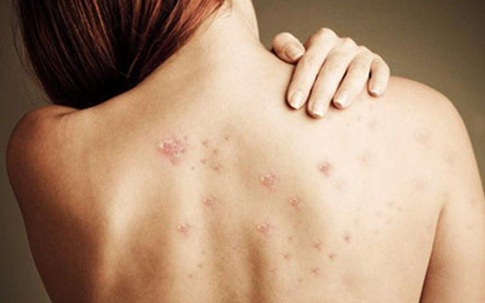 Image showing small dark and reddish spots on the upper back skin.