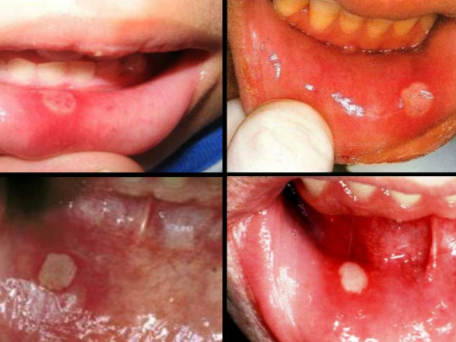 Close-up views of aphthous mouth ulcers on the inner lip and cheek, showing small round white sores with red, inflamed borders inside the mouth.