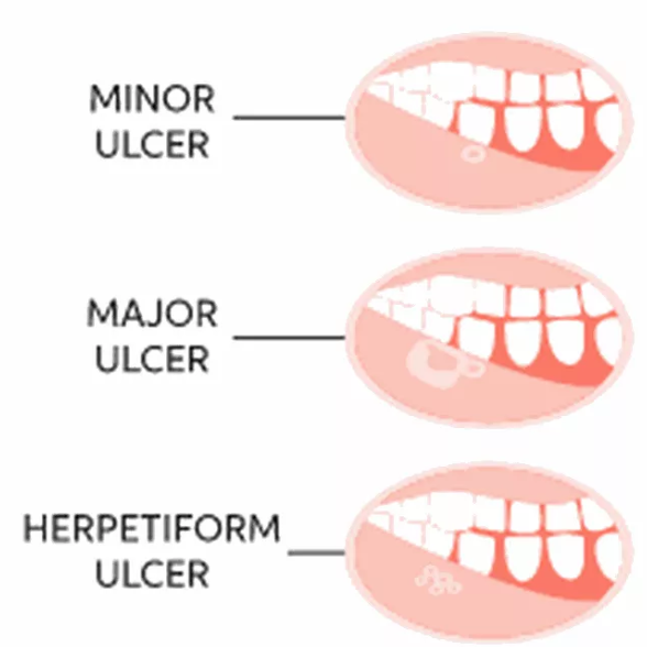 Illustration showing types of mouth ulcers: minor ulcer, major ulcer, and herpetiform ulcer, labeled and compared inside the mouth.