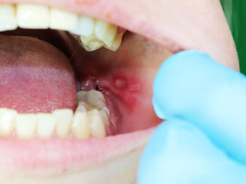 Close-up of a mouth ulcer on the inner cheek near the molars, showing a red inflamed sore with a white center being examined by a gloved hand.
