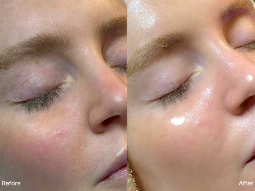 Before and after comparison showing improved skin glow and hydration following a Hydrafacial treatment.