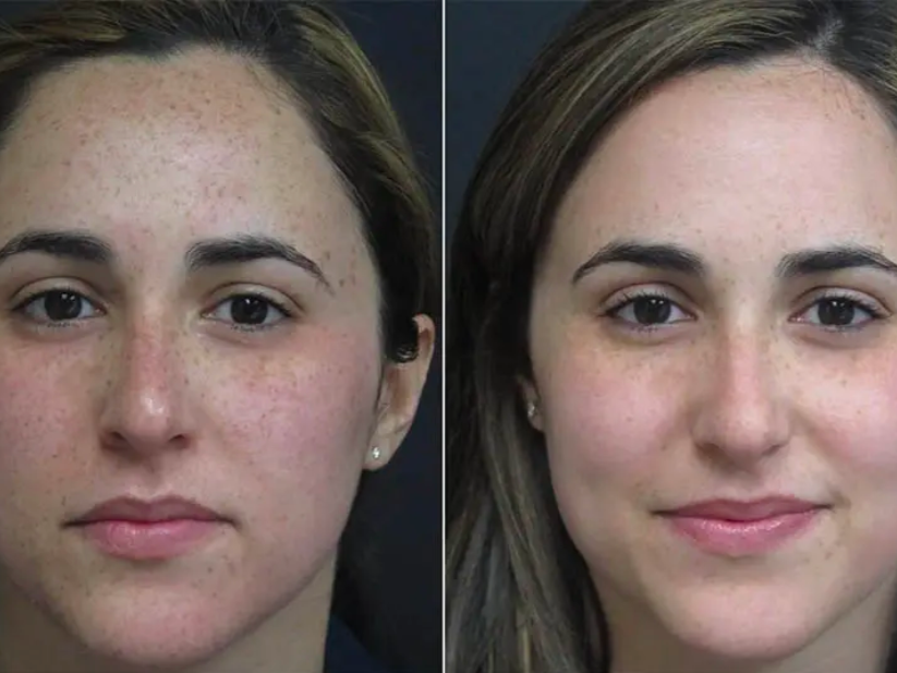 Before and after facial images showing improved skin tone and reduced pigmentation following a skincare treatment.