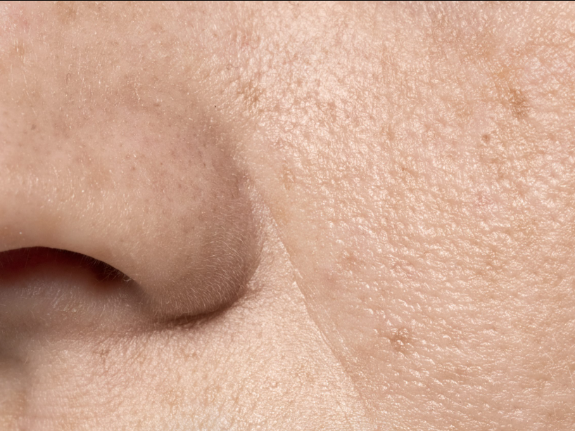 Detailed close-up of cheek and nose area showing enlarged pores and natural skin texture.