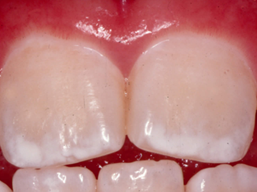 Close-up of front teeth showing white chalky spots on the enamel near the gum line.