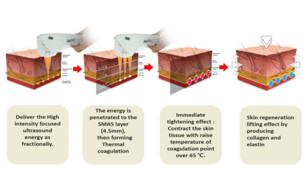Diagram showing how HIFU ultrasound energy targets deeper skin layers to stimulate collagen.
