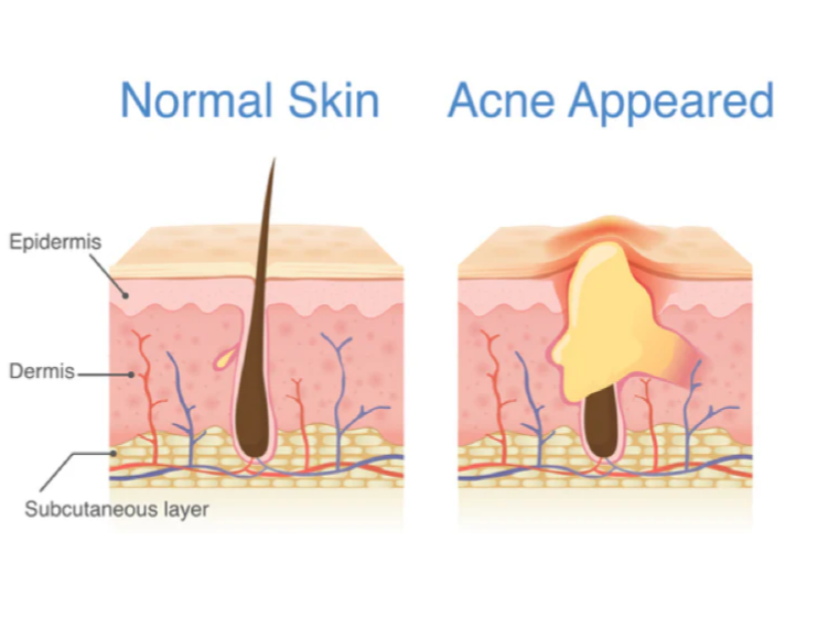 Diagram comparing normal skin and acne appeared skin layers, explaining inflammation that leads to acne scars.