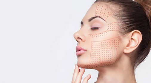 Facial contour mapping on a woman’s face illustrating targeted HIFU skin tightening treatment areas.