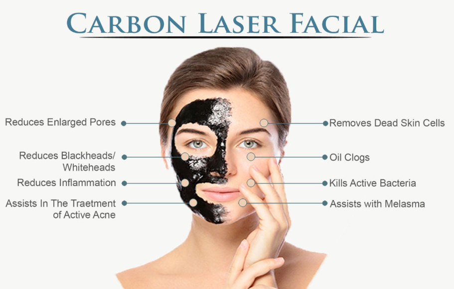 Carbon laser benefits for acne, pores, pigmentation and glow