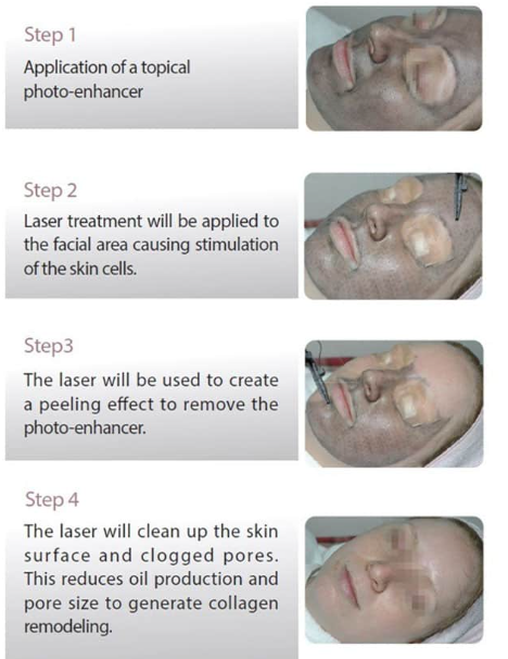 Step-by-step carbon peel laser facial procedure